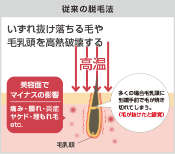 世の中のレーザー・光脱毛のメカニズム